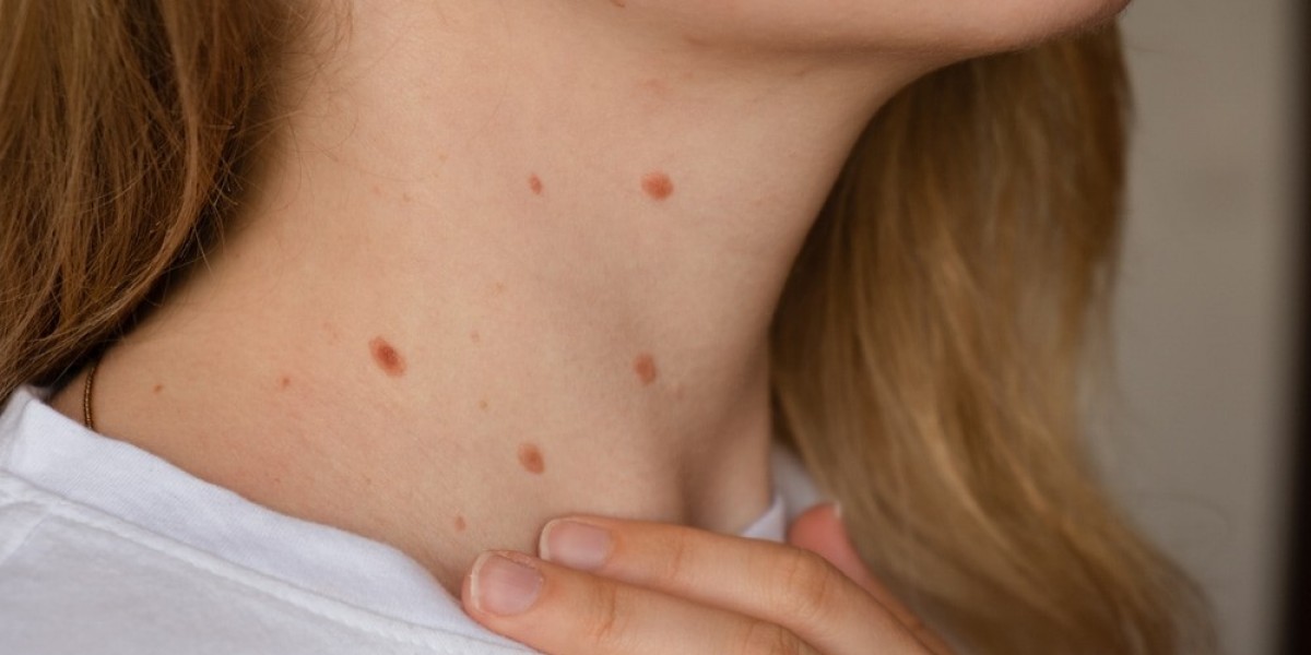Skin Tags Explained: Are Skin Tags Contagious