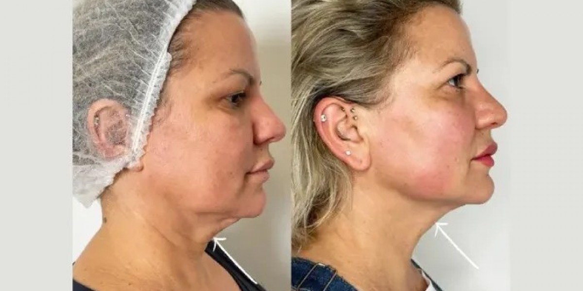 Endolift Recovery Tips from Best Plastic Surgeon in Dubai