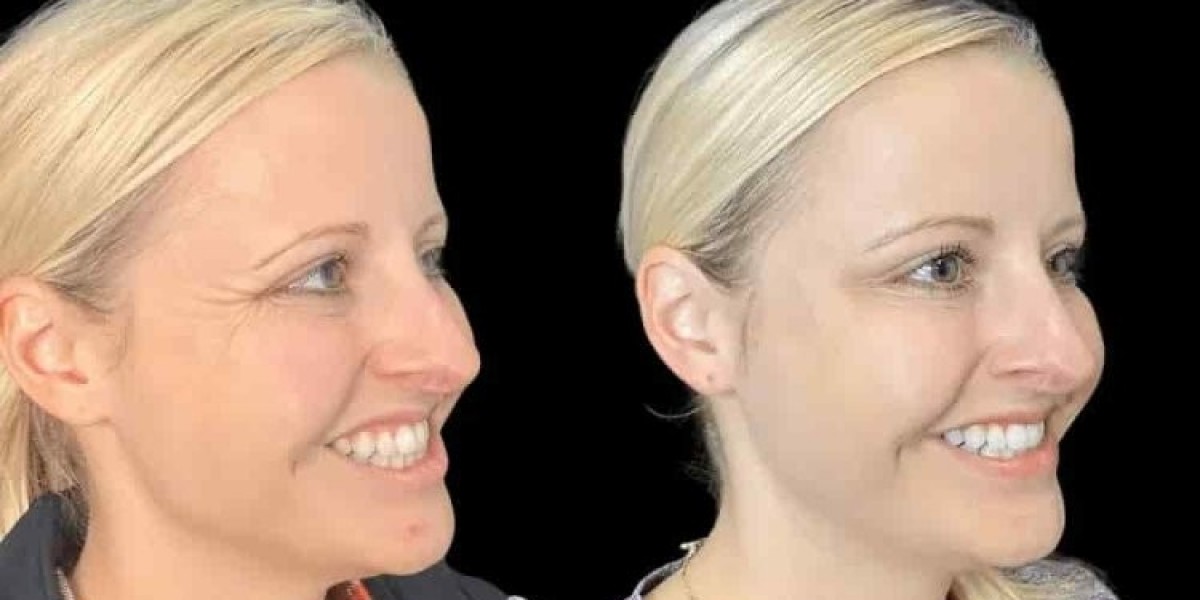 Best Aesthetic Clinic in Dubai for Botox with Exceptional Patient Care