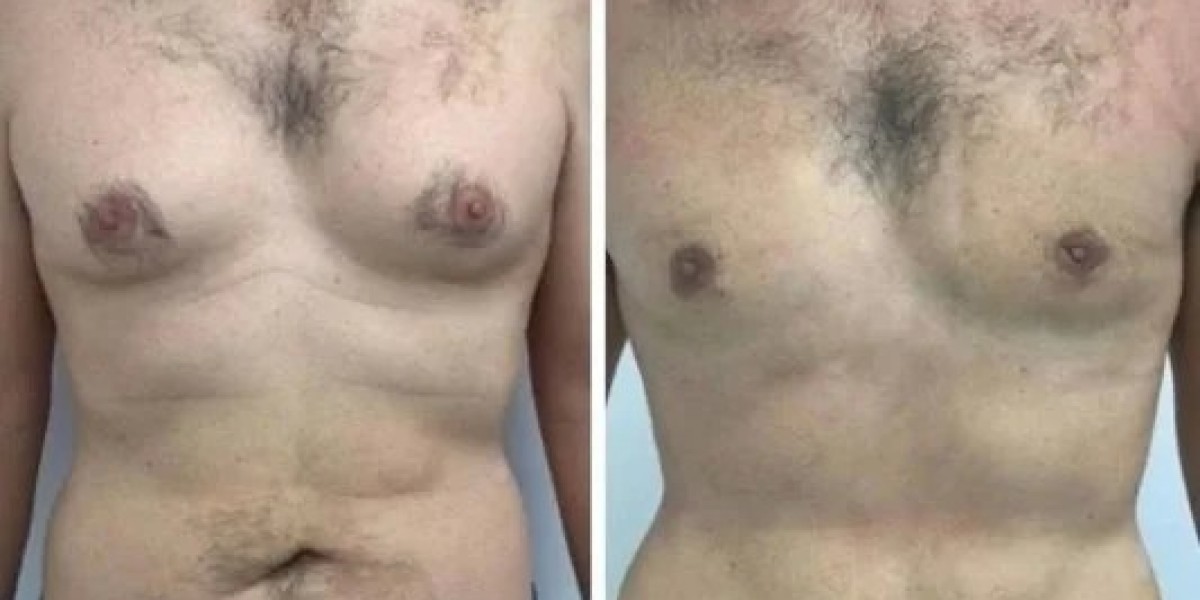 Best Gynecomastia Surgeons in Dubai: Why Experience Matters in Revision Surgery
